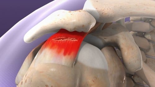 Omuz Tendon Kas Yırtıkları